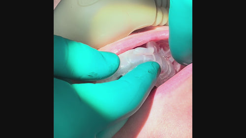 ApexGUIDE endodontic surgical guide used during real apicoectomy surgery with post operative x ray showing precise apex resection